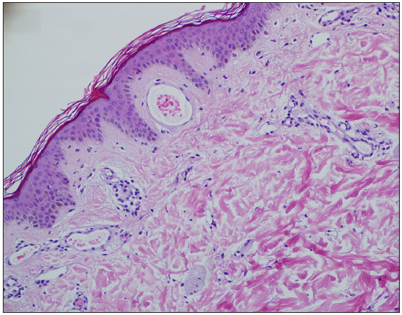 Enlargement of thin-walled capillaries in the dermis, but no capillary wall thickening or vascular endothelial cell proliferation (Haematoxylin-eosin staining, 200x).