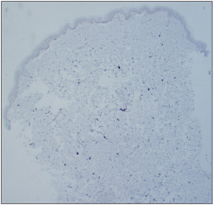 Negative oestrogen receptor staining (50x).