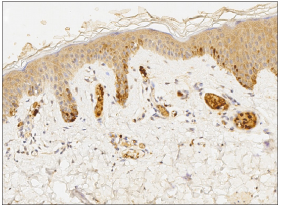 Positive vascular endothelial growth factor staining (200x).