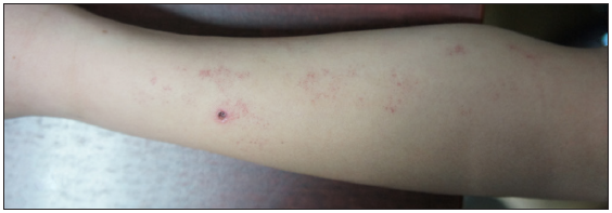 Skin lesions of patient 1 before treatment.