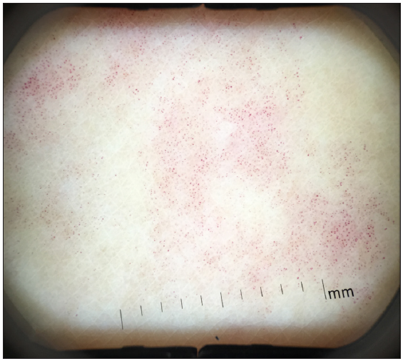 Dermatoscopic findings before treatment (DermaScope, polarised light, 8x).