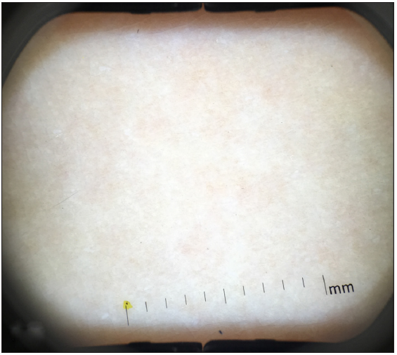 Dermatoscopic findings after treatment (DermaScope, polarised light, 8x).