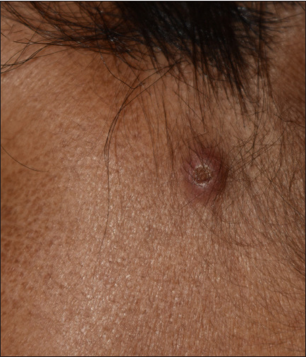 Umbilicated papule over the left temporal area.