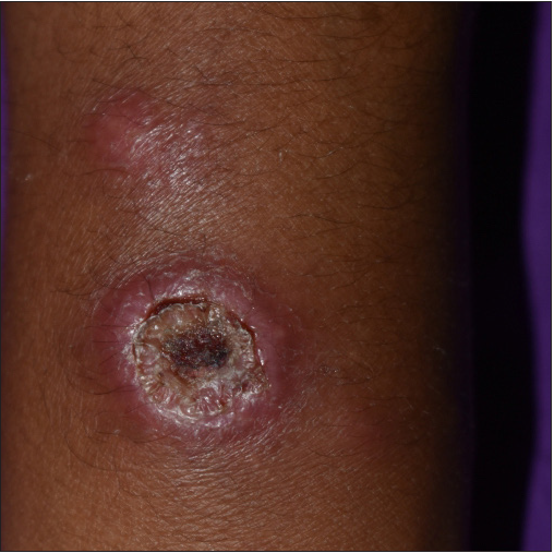 Erythematous nodule over the left forearm.