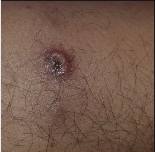 Umbilicated crusted plaque over the left leg.