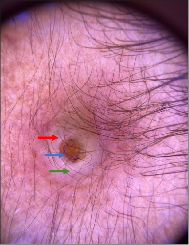 Dermoscopy of the crusted papule showing central yellowish keratotic plug (blue arrow) with surrounding yellow-white rim (green arrow) containing ill-focused vessel focally (red arrow) (Polarised mode, 10x).