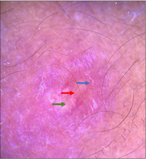 Dermoscopy of erythematous nodule showing irregular vessel (red arrow) on a yellow background (green arrow) with surrounding erythema and scaling (blue arrow) (Polarised mode, 10x).