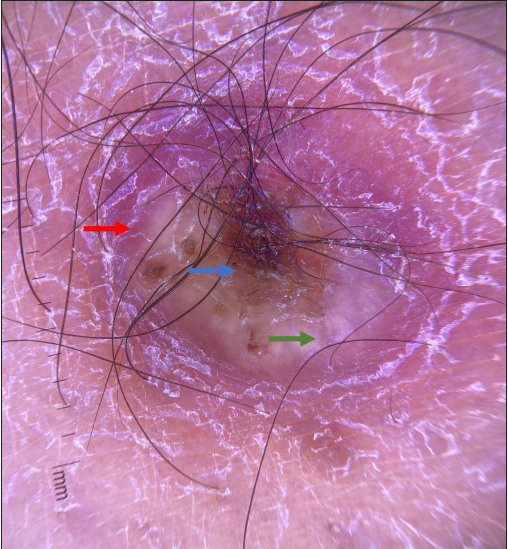 Dermoscopy of the crusted plaque showing central brown crusting (blue arrow) with surrounding yellow-white structureless area (green arrow), erythema and scaling (red arrow). (Polarised mode, 10x).