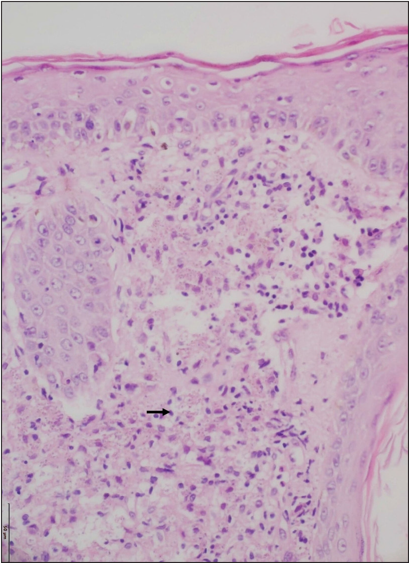 Skin biopsy shows the presence of numerous histiocytes with abundant foamy cytoplasm in the dermis (black arrow) (Haematoxylin and eosin, 200x).