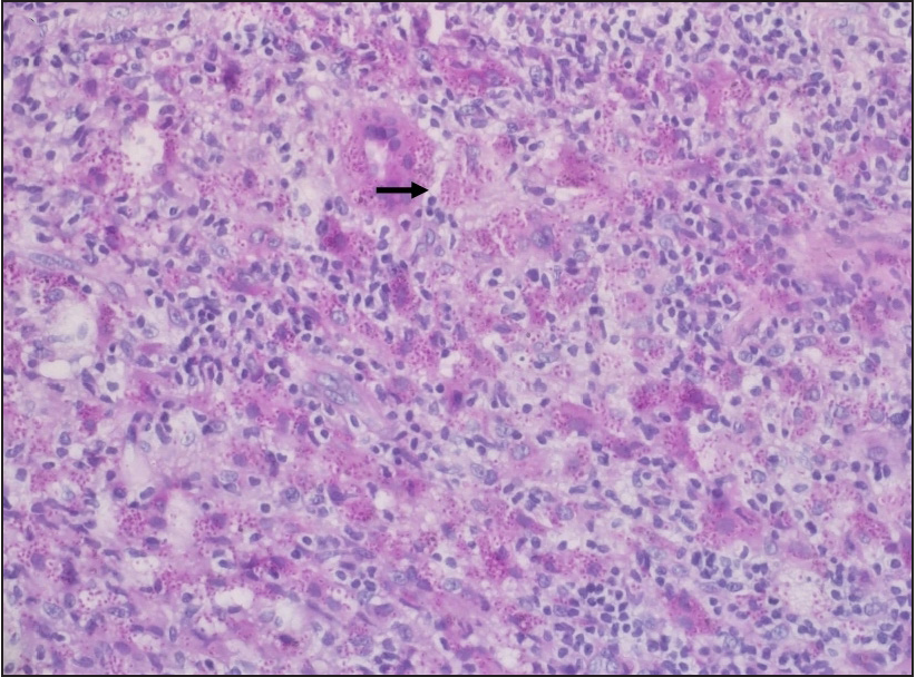 Many intracytoplasmic fungal spores are highlighted by Periodic acid-stain (black arrow) (200x).