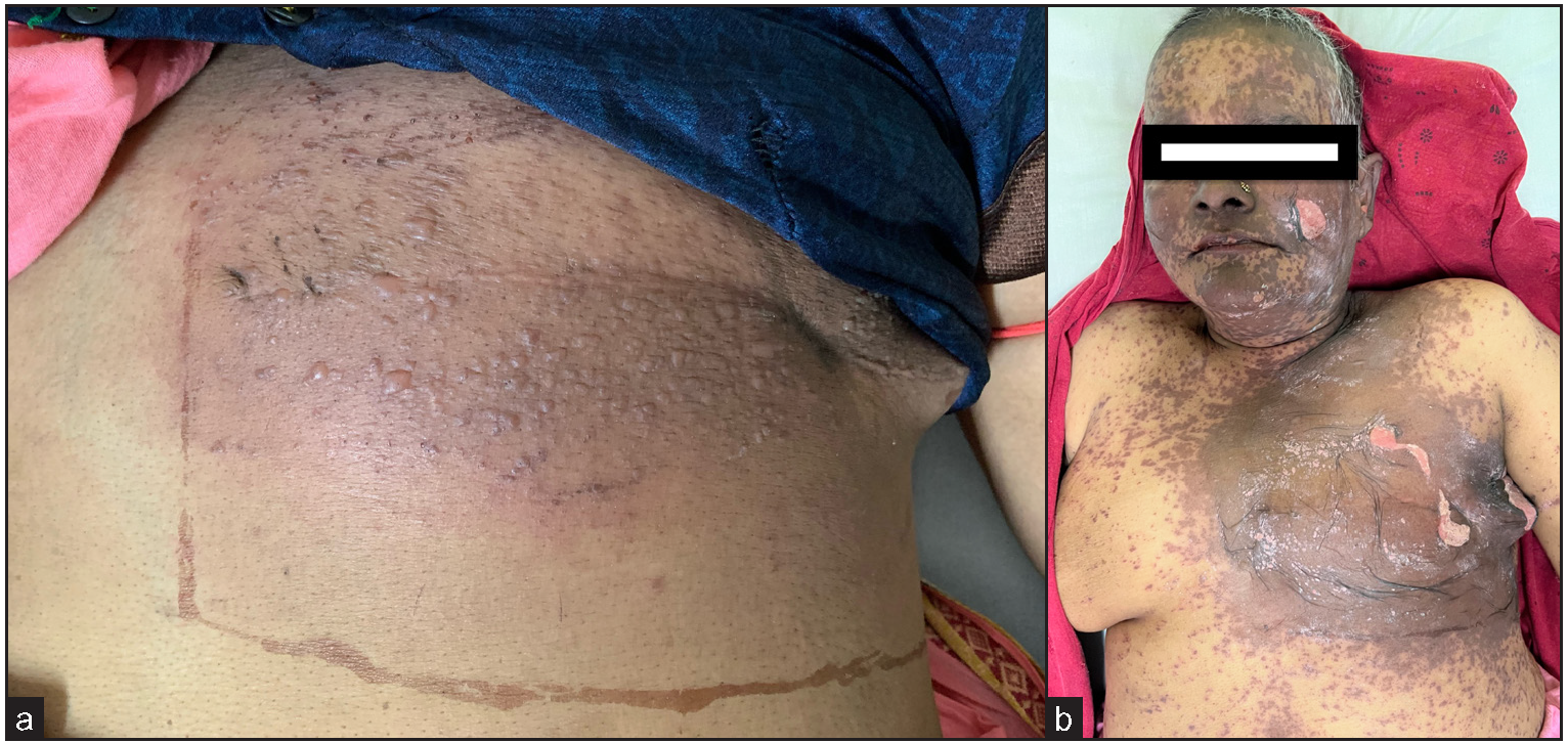 (a) Multiple vesicles and bullae seen limited to the site of radiotherapy; (b) Extensive involvement of face and trunk in the form of purpuric macules and epidermal detachment localised to radiotherapy site.