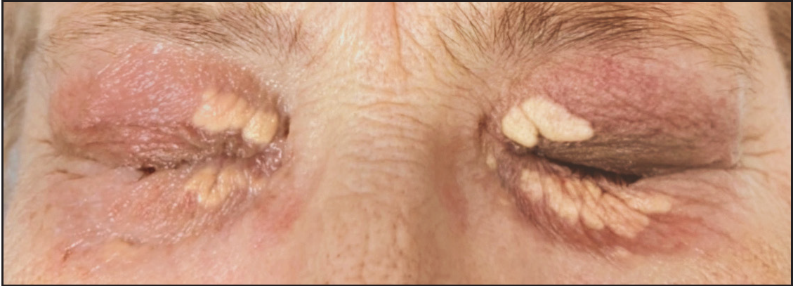 A 72-year-old lady with bilateral grade III xanthelasma palpebrarum.