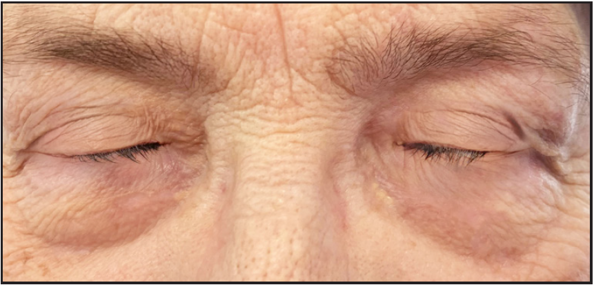 Clearance of bilateral grade III xanthelasma palpebrarum, two months after the copper vapour laser treatment.