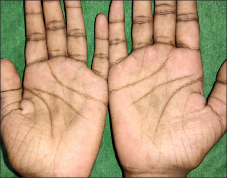 Showing multiple tiny skin-coloured to hyperpigmented papules and depressions on the central aspect of both palms.