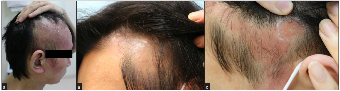 Three men with severe atopic dermatitis (a) 28-year old, (b) 47-year old and (c) 25-year old, presented with erythematous, diffuse, non-scarring alopecic patches on the frontal and parietal scalp following the use of dupilumab.