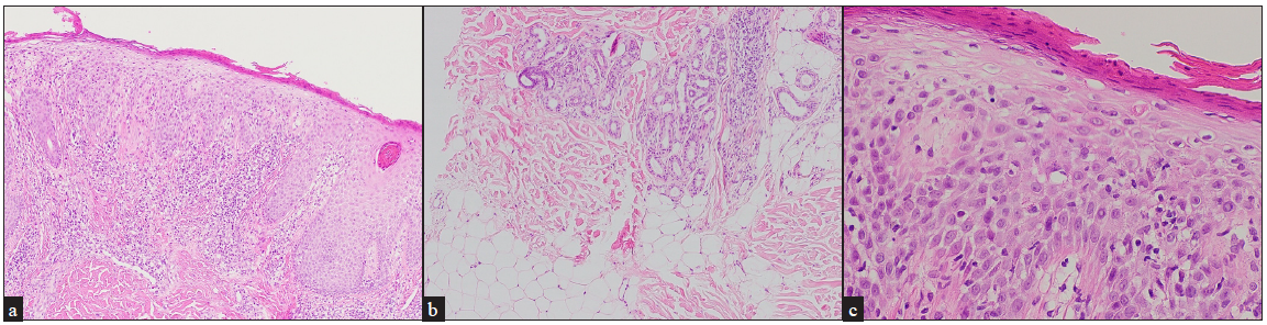 Haematoxylin and eosin stained tissue sectioned showing parakeratosis, irregular acanthosis, and noticeable spongiosis with perivascular, lymphocytic infiltratio mainly in the papillary dermis, resembling subacute eczematous dermatitis. Note there is no terminal hair or increased catagen/telogen hairs. (a) 40x, (b) 100x and (c) 400x magnification.