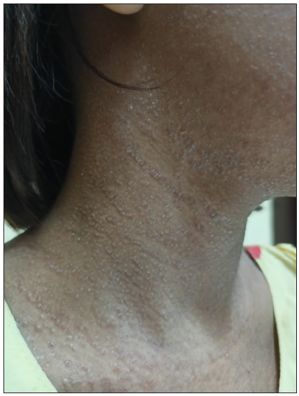 Lesions treated with antifungals had healed with hypopigmentation at places.