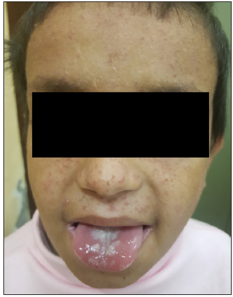 The younger brother of the child with similar cutaneous lesions and oral candidiasis.