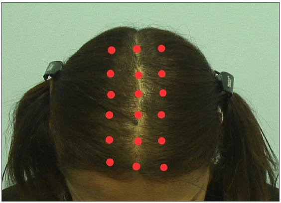 Treatment plan: approximately 0.1 cc was injected into each red dot represented in the figure with a threaded syringe and 31 g needle at a 45-degree angle.