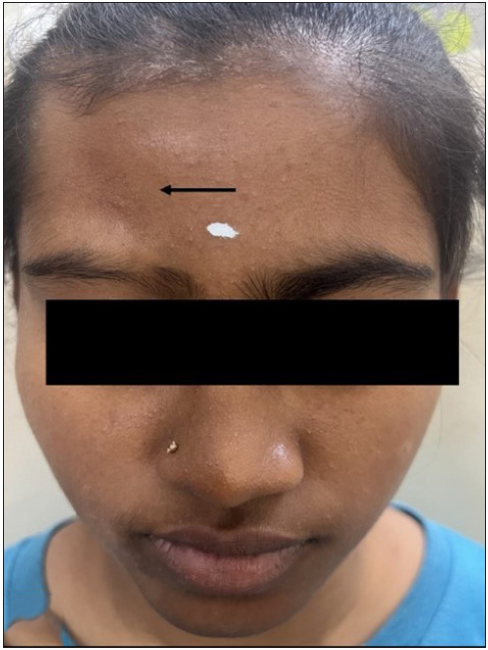 Linear morphea (black arrow) affecting the frontoparietal region.