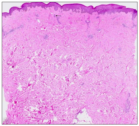 Top-heavy sclerosis with follicular remnants seen as columnar, basaloid structures (black arrow). (Haematoxylin and eosin,10x)