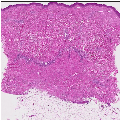 Bottom-heavy sclerosis. (Haematoxylin and eosin, 20x)