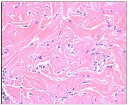 ‘Scattered interstitial’ pattern of lymphocytes amidst the sclerotic collagen. (Haematoxylin and eosin, 400x)