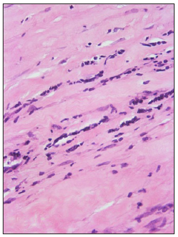 Lymphocytes in linear arrays, the ‘Indian file’ pattern. (Haematoxylin and eosin, 400x)