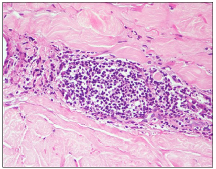 ‘Lymphoid aggregate’ formation. (Haematoxylin and eosin, 400x)