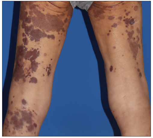 Asymptomatic, extensive brownish macules and patches on the lower limbs.