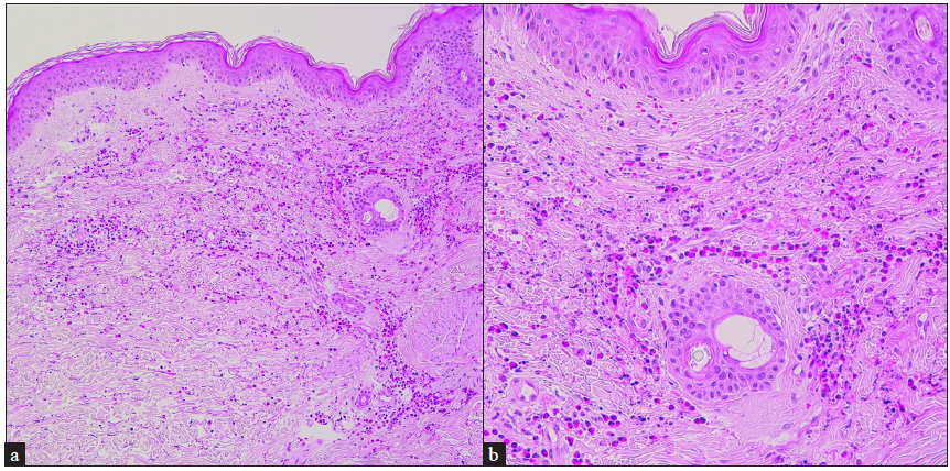 Diffuse perivascular and interstitial eosinophil infiltrations extravasation of red blood cells, and nuclear debris throughout the dermis on Haematoxylin and eosin stained skin biopsy; (a) 100x and (b) 200x.