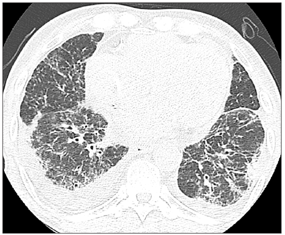 Coarse ground glass opacity in the entire lung accompanied with bilateral pleural effusion was found by computed tomographic scan on the chest.