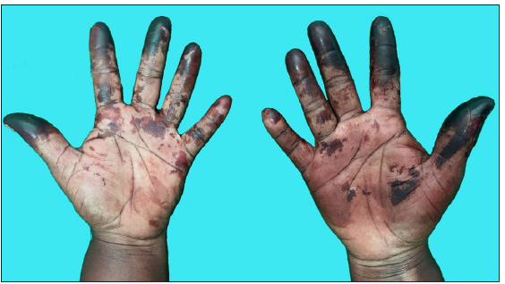 Brownish discolouration of the bilateral palms.