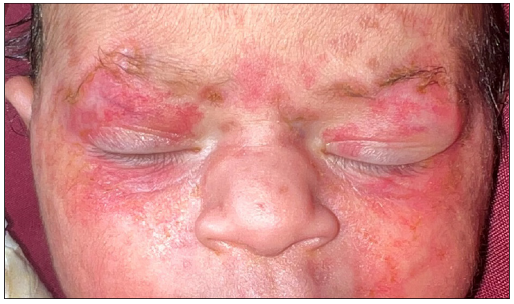 Multiple, discrete, and confluent, erythematous papules and plaques distributed on the bilateral malar area, periorbital area, and the nose.