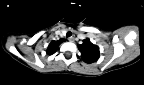 Computed tomography scan of the neck at the axial plane above the sternoclavicular joint shows bilateral, mildly enhancing lesions in the subcutaneous plane anterior to the sternal part of the sternocleidomastoid (white arrows). The lesions are ill-defined and hyper to isodense.
