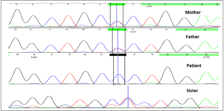 Sanger sequencing showing homozygous variation in the proband as compared to parents and sibling.