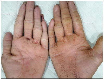 Palmar keratoderma.