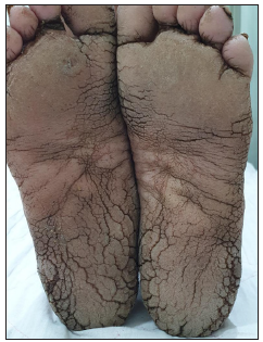 Plantar keratoderma.
