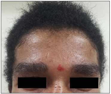 Scalp and eyebrows showing woolly hair.