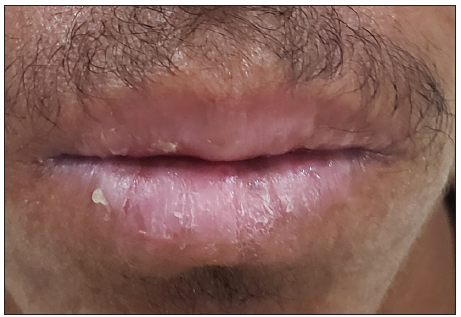 Erosions and scaling of lips.