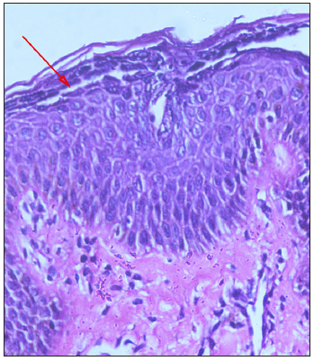 Histopathology of skin ((Haematoxylin and Eeosin 40x) staining under 40 magnification) with arrow showing the blister.