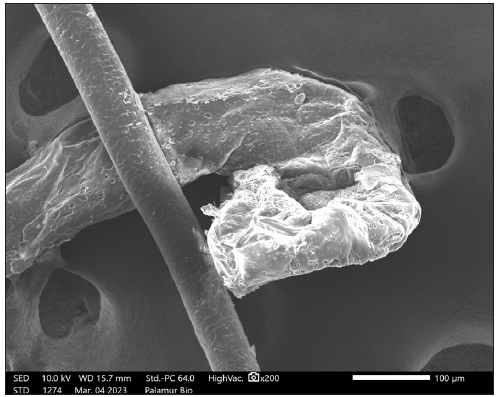 Scanning electron microscopic (SEM) image of hair showing dystrophic anagen root.