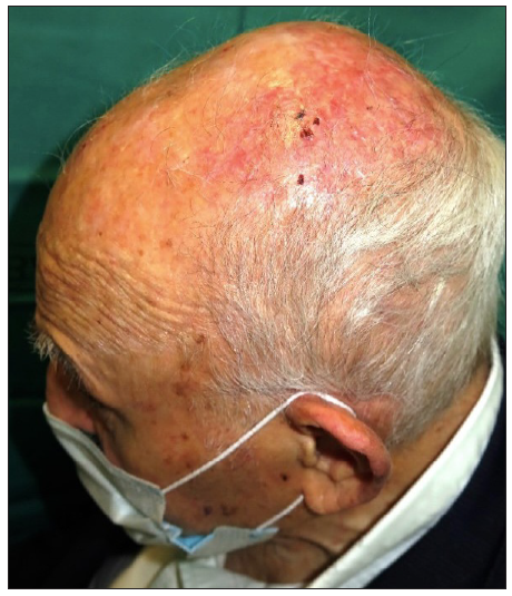 Complete regression of tumoural lesion after 26 weeks.