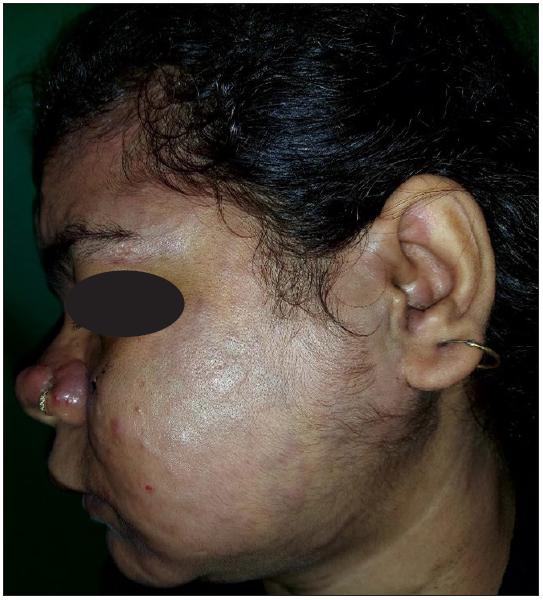 Violaceous hue in plaques on the cheek.