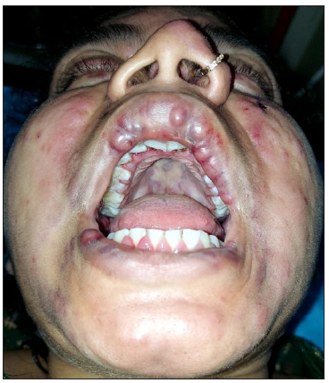 Gum hypertrophy, mucosal nodules and haemorrhagic plaques.