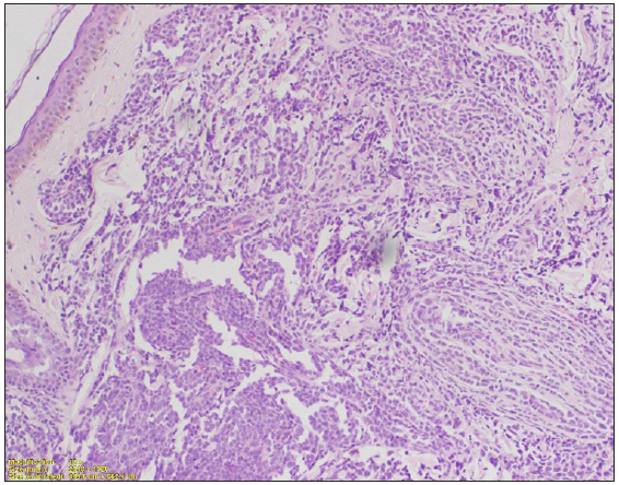 Dense diffuse dermal infiltrate beneath a well-formed grenz zone, with areas of Indian file arrangement. Infiltrate is composed of large lymphoid cells with hyperchromasia, mitotic figure and crush artefacts. (Haematoxylin and eosin, 100x).