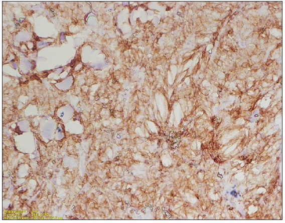 Special stains positive for myeloid lineage in immunohistochemistry (CD117, membranous staining, 200x).