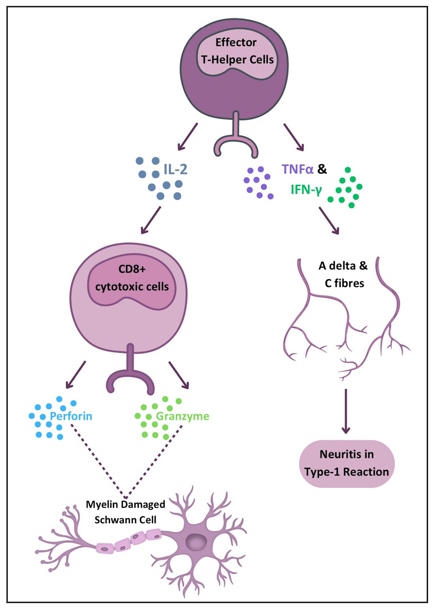 Diagram illustrating the immune response in Type 1 reaction leading to neuritis and nerve damage. (CD8: Cluster of differentiation 8, IFN: Interferon, IL: Interleukin, TNF: Tumour necrosis factor.)