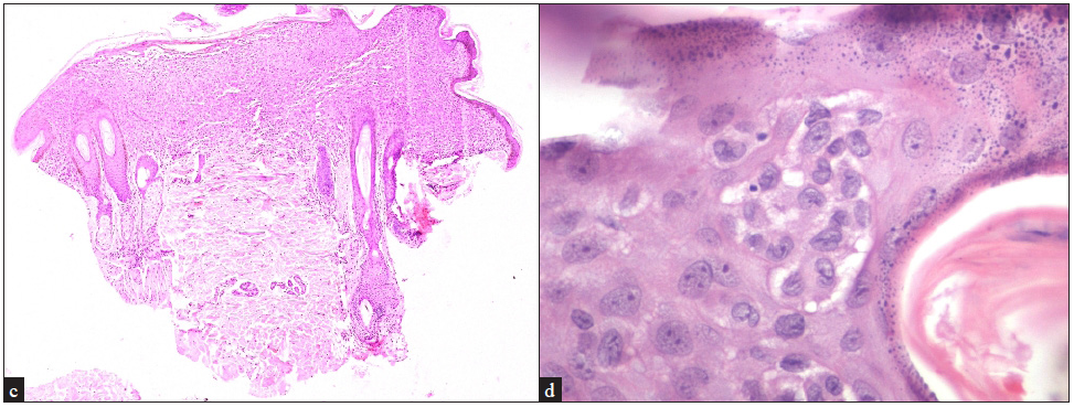 (c) Confluent (band-like) infiltrate of Langerhans cells in the papillary and upper reticular dermis horizontal disposition with overlying marked basal cell degeneration (Haematoxylin & eosin, 40x), (d) Clustered Langerhans cells in the epidermis beneath the granular layer (Haematoxylin & eosin, 400x).