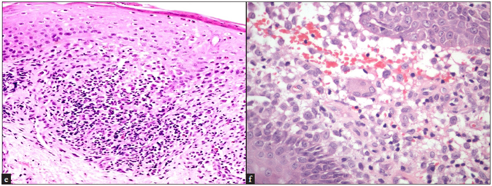(e) Isolated Langerhans cells exocytosis in the basal layer of the epidermis, eosinophilic exocytosis in the upper, mid and lower layers of the epidermis and multiple eosinophils in the upper dermis, (Haematoxylin & eosin, 200x), (f) Langerhans cells forming a giant cell along with significant RBC extravasation and marked oedema (Haematoxylin & eosin, 400x).